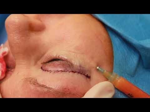 مراحل تزریق چربی در صورت و گردن