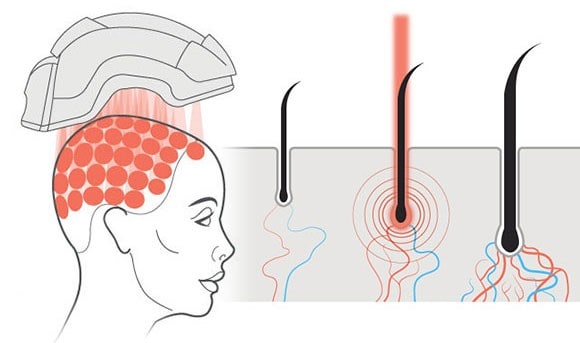 نحوه عملکرد لیزرتراپی در درمان ریزش مو