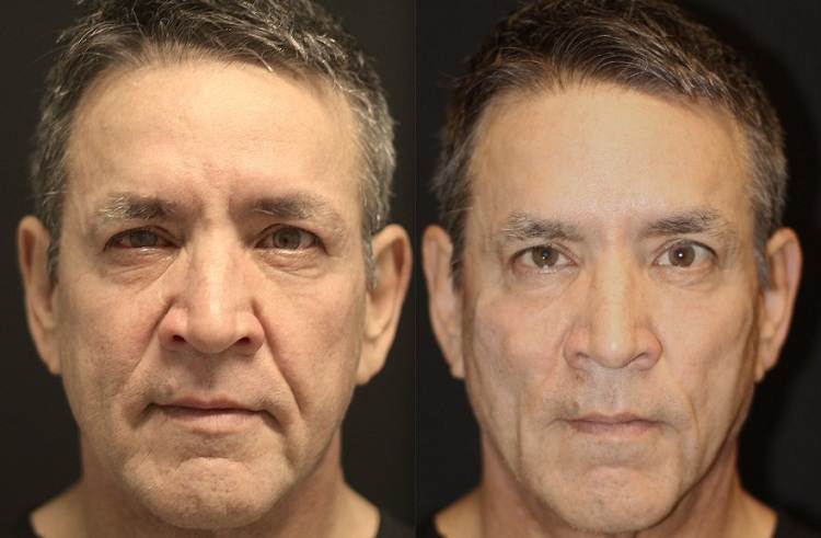 عکس قبل و بعد لیفت صورت با نخ و نتایج حاصل شده 3