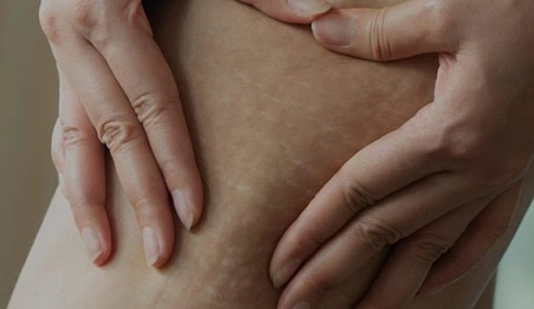 مناطقی از بدن که بروز ترک پوستی در آنها رایج است.