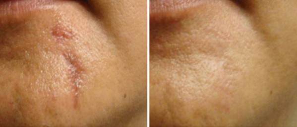 نتایج چشمگیر درمان با کربوکسی تراپی برای نقاط مختلف صورت و بدن 4