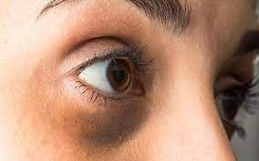 بهترین روش‌های درمان سیاهی دور چشم