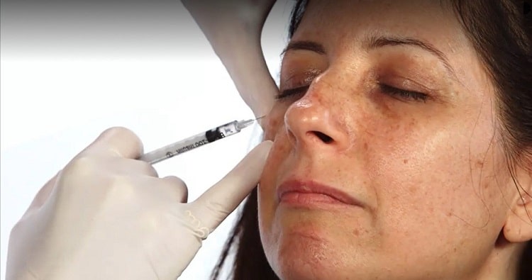 درمان سیاهی دور چشم با تزریق ژل