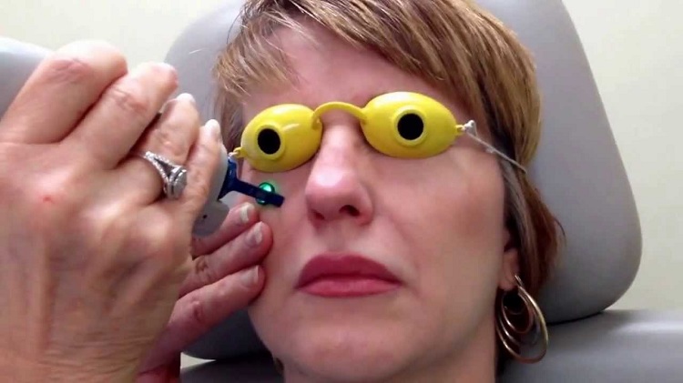 درمان سیاهی دور چشم با لیزر